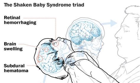 This is a severe brain injury that can <b>cause</b> the brain to swell and bleed. . Shaken baby syndrome cause autism